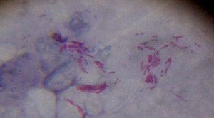 結(jié)核病顯微鏡圖片